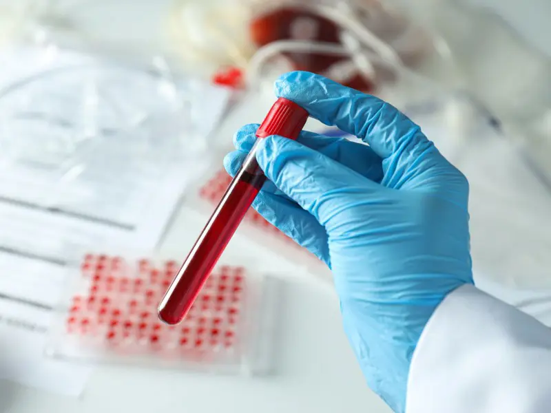 HEMATOLOGIA - HEMOSTÀSIA